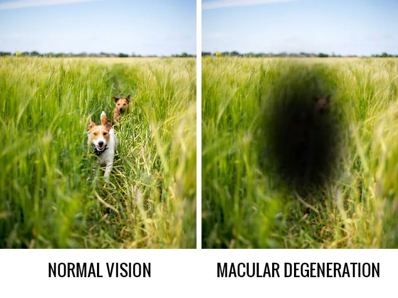 Age-related macular degeneration — AMD for Greater Independence in Everyday Life