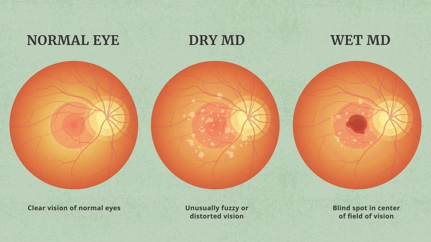 Age-related macular degeneration — AMD for Greater Independence in Everyday Life