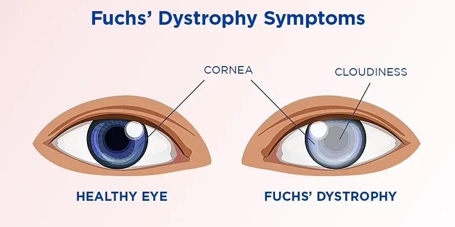 Corneal dystrophies for Greater Independence in Everyday Life