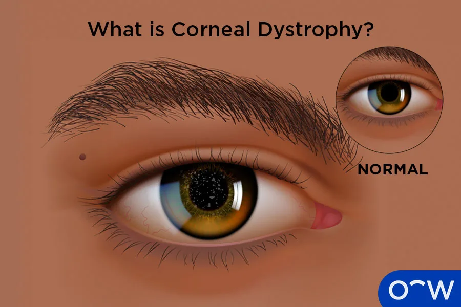 Corneal dystrophies for Greater Independence in Everyday Life