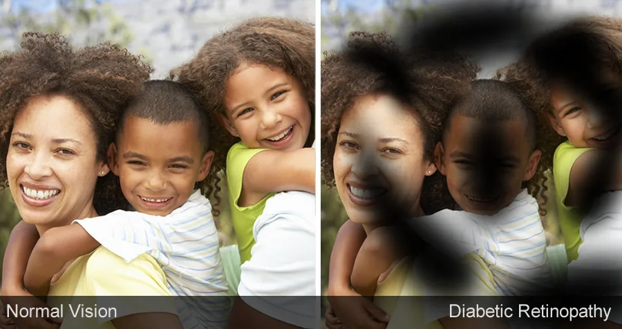 Diabetes related eye conditions including Diabetic Retinopathy